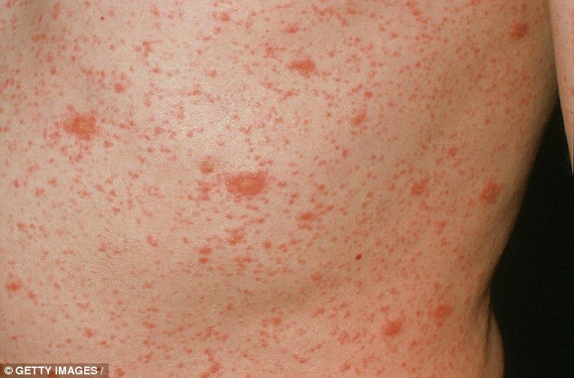 Lichen planus is an itchy rash that affects about 1 per cent of the population, usually from middle age. It causes small, purple-red raised bumps a few millimetres wide