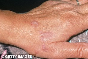 Lichen planus is a non-infectious, itchy rash that can affect many areas of the body