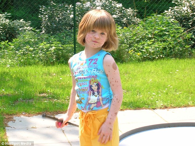 Manchester Girl Covered In Birthmarks Was Bullied For Looking Like A