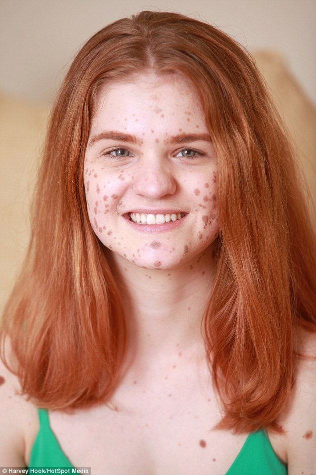 Manchester Girl Covered In Birthmarks Was Bullied For