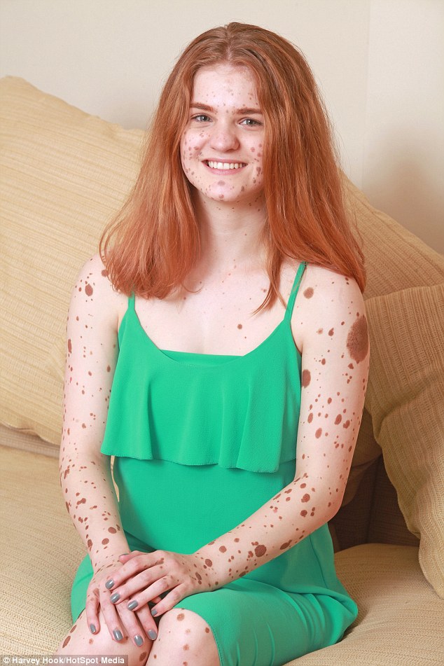 Manchester Girl Covered In Birthmarks Was Bullied For Looking Like A